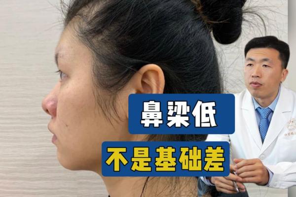 低鼻梁怎么办 低鼻梁怎么办