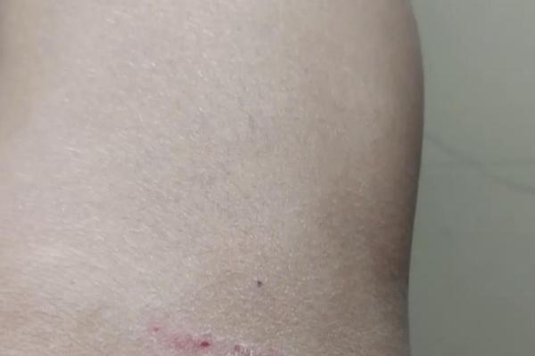 女人梦见狗咬是什么预兆