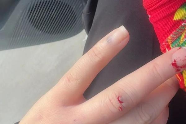 女人梦见狗咬手是要发财